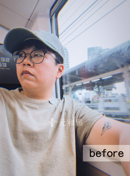 天鵝頸術前照片 天鵝頸術前照片