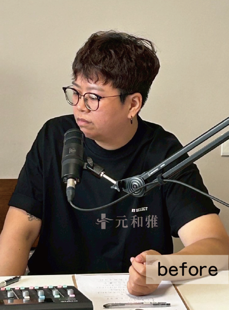 天鵝頸術前照片 天鵝頸術前照片