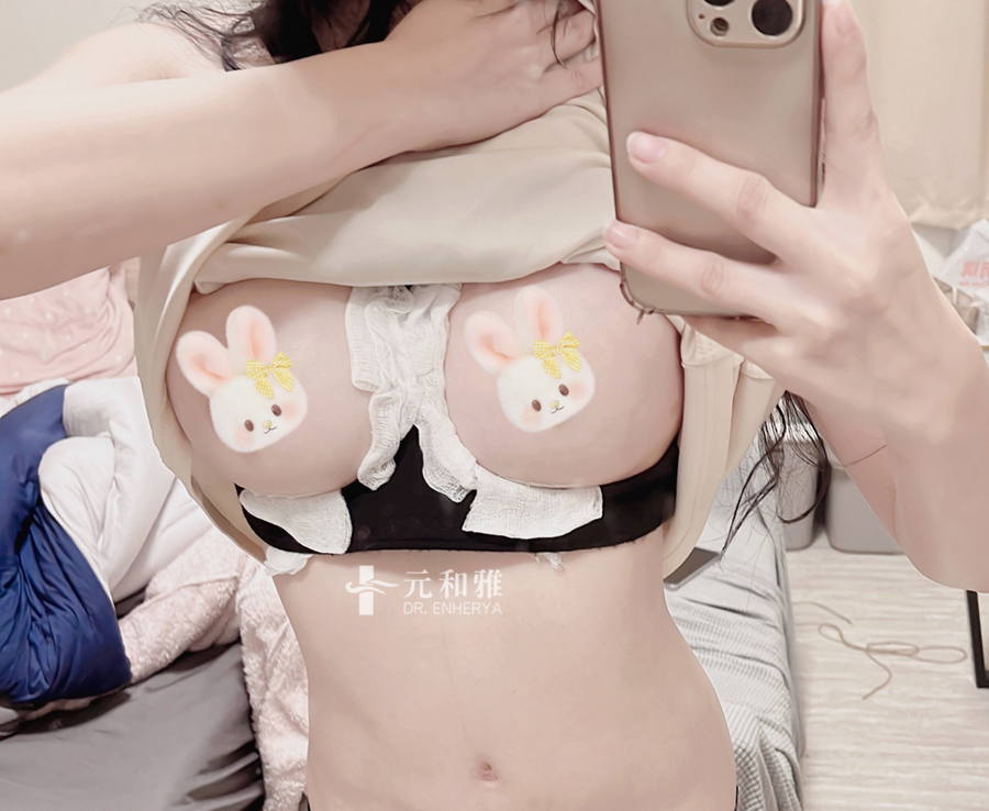 女王波隆乳術後