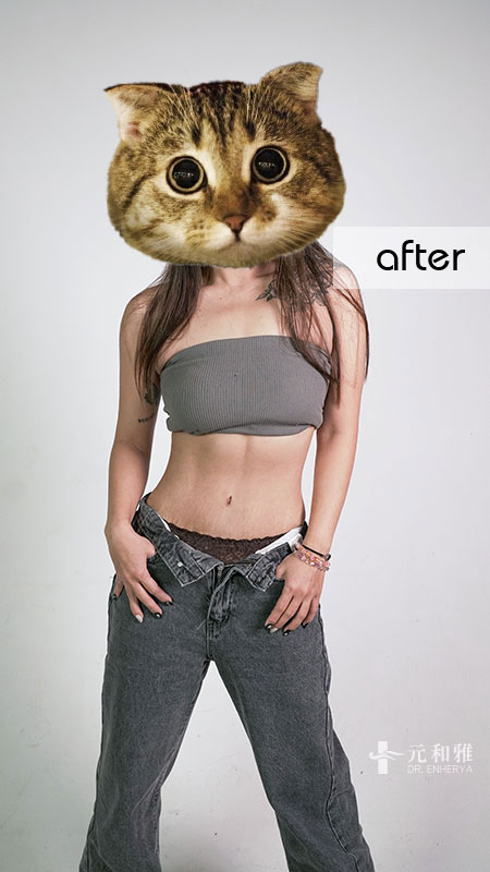 台南腹部拉皮推薦案例_產後腹部凸塊改善術(後)