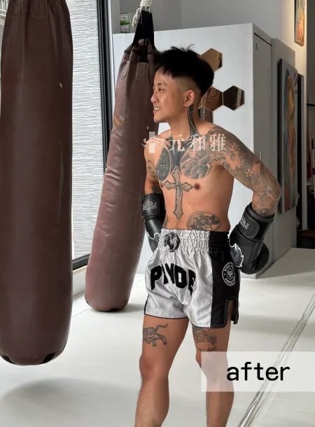 2026高雄平胸手術術後案例 2026高雄平胸手術術後案例