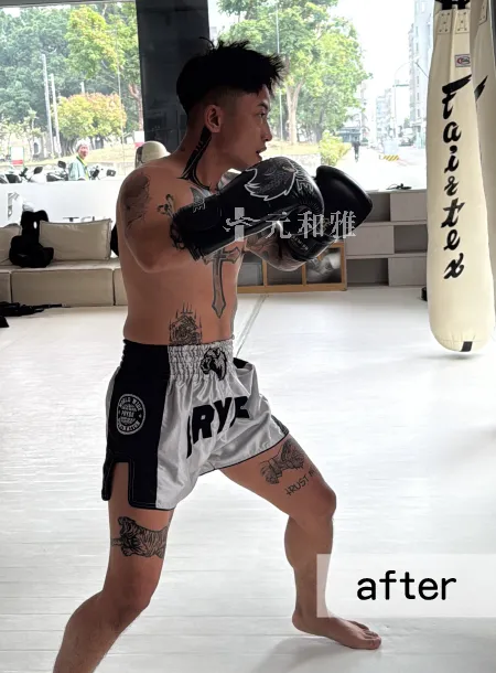 2026高雄平胸手術術後案例 2026高雄平胸手術術後案例