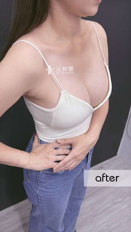 盈波隆乳 盈波隆乳