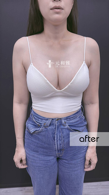 盈波隆乳 盈波隆乳
