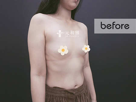 盈波隆乳 盈波隆乳