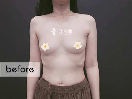 珍珠波隆乳 珍珠波隆乳