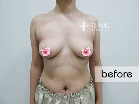 女王波適合對象, 隆乳經驗談 女王波適合對象, 隆乳經驗談