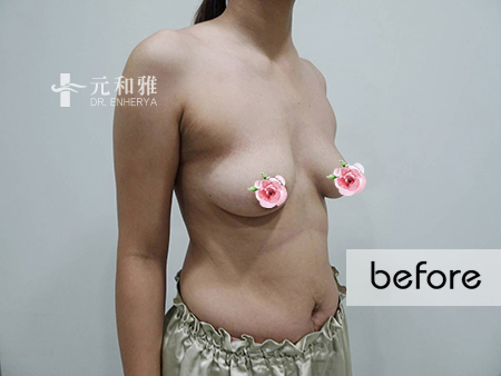 女王波適合對象, 隆乳經驗談 女王波適合對象, 隆乳經驗談