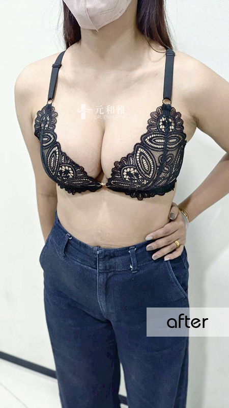 女王波適合對象, 隆乳經驗談 女王波適合對象, 隆乳經驗談