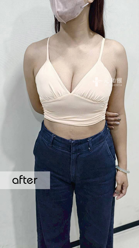 女王波適合對象, 隆乳經驗談 女王波適合對象, 隆乳經驗談