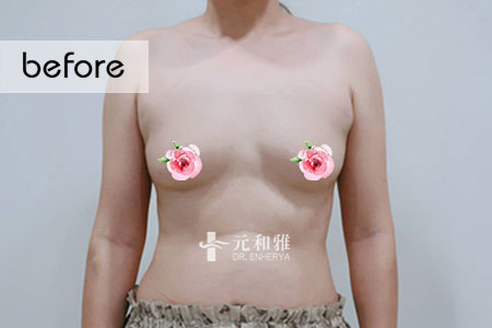 珍珠波隆乳經驗
