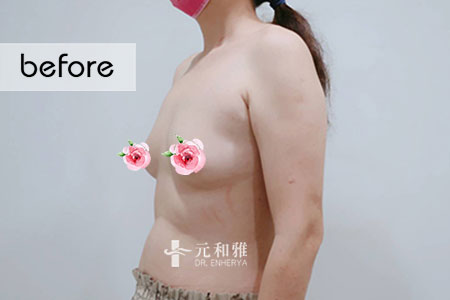 隆乳恢復過程