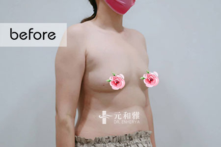 產後隆乳選擇