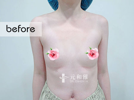 隆乳尺寸選擇