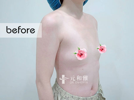 隆乳經驗分享