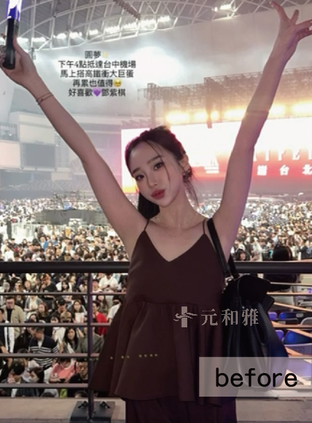 綠妹魔滴2.0隆乳術前胸型紀錄 綠妹魔滴2.0隆乳術前胸型紀錄