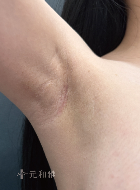 綠茶一個月腋下隆乳術後傷口 綠茶一個月腋下隆乳術後傷口