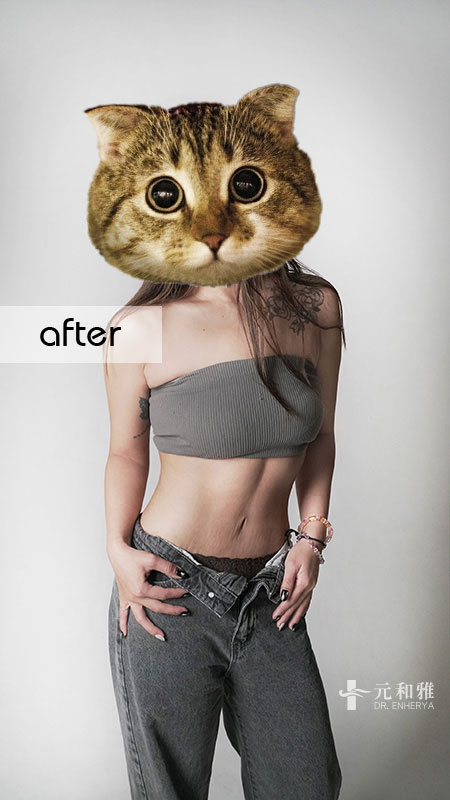 台南腹部拉皮推薦案例_產後腹部凸塊改善術(前)