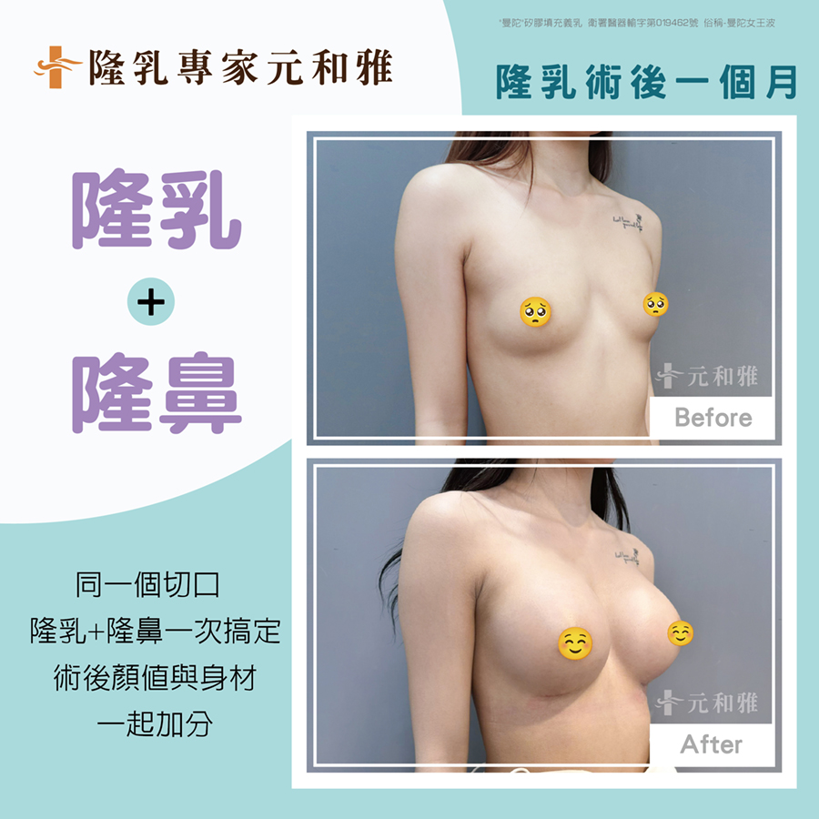 台北女王波隆乳手術費用