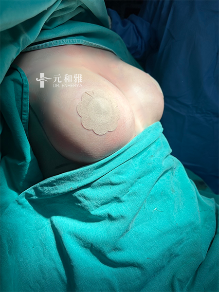 隆乳手術副作用, 二次隆乳案例分享, 重建胸型