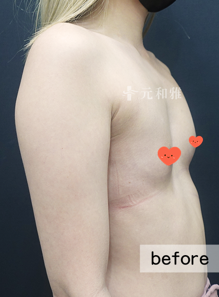 元和雅珍珠波隆乳術前案例 元和雅珍珠波隆乳術前案例