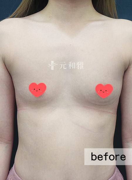 珍珠波隆乳術前案例 珍珠波隆乳術前案例