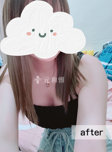 珍珠波隆乳術後案例 珍珠波隆乳術後案例