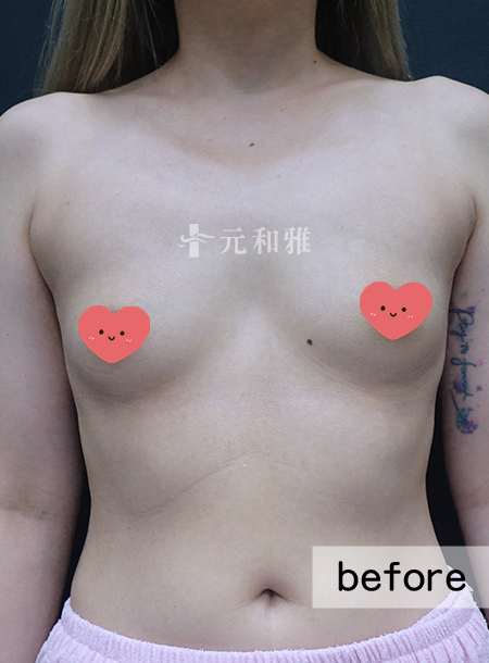 魔滴隆乳2.0術前案例 魔滴隆乳2.0術前案例