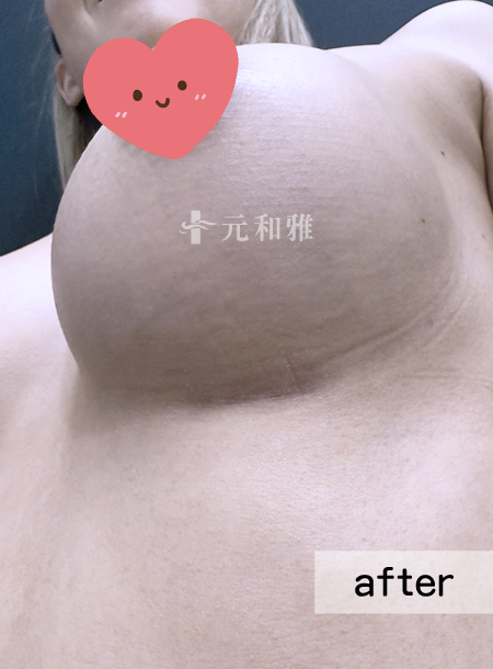 台南元和雅魔滴隆乳2.0術後傷口 台南元和雅魔滴隆乳2.0術後傷口
