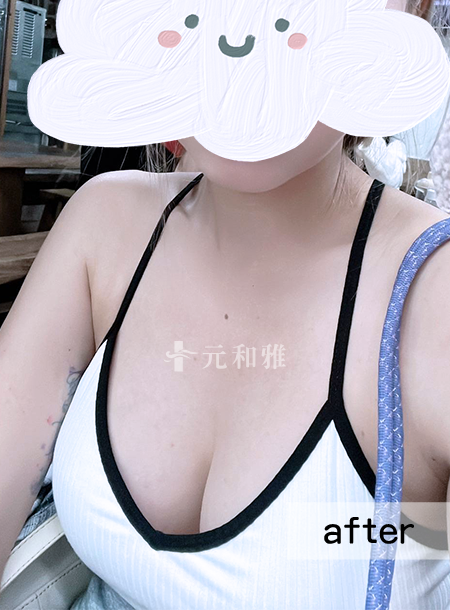 魔滴隆乳2.0術後案例 魔滴隆乳2.0術後案例