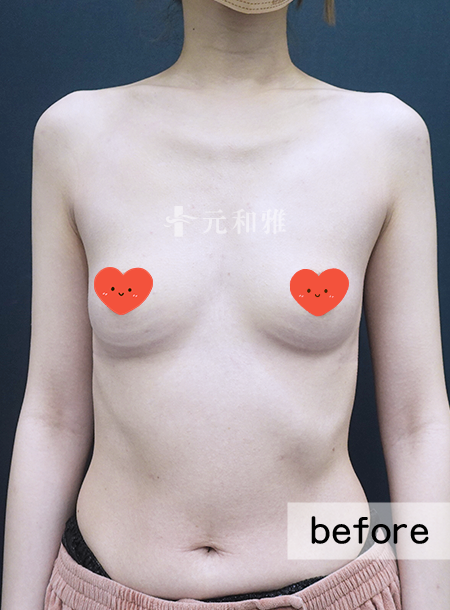 魔滴2.0隆乳術前案例 魔滴2.0隆乳術前案例