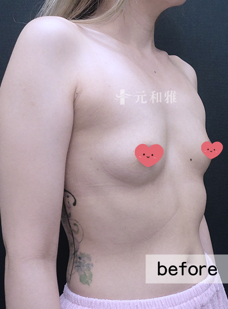 元和雅魔滴隆乳2.0術前案例 元和雅魔滴隆乳2.0術前案例