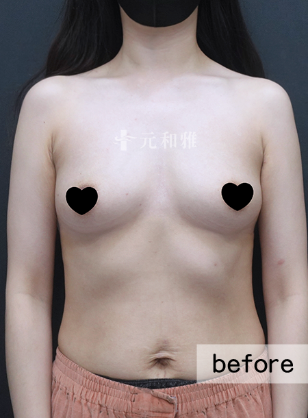 魔滴隆乳2.0術前案例 魔滴隆乳2.0術前案例