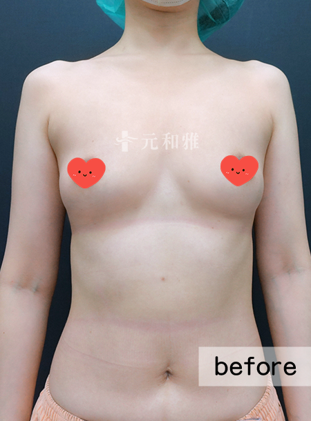 魔滴2.0隆乳術前案例 魔滴2.0隆乳術前案例