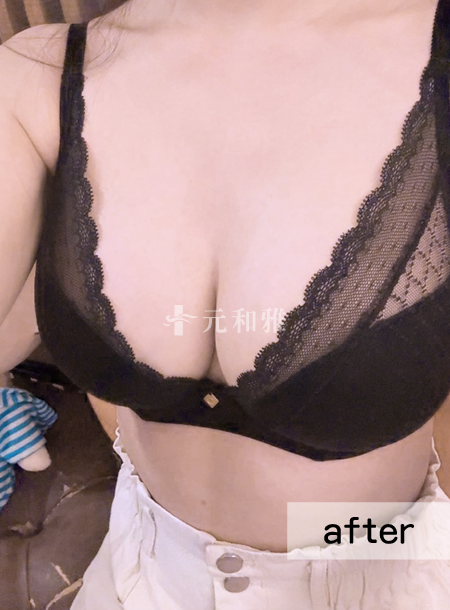 台南元和雅魔滴2.0隆乳術後案例 台南元和雅魔滴2.0隆乳術後案例