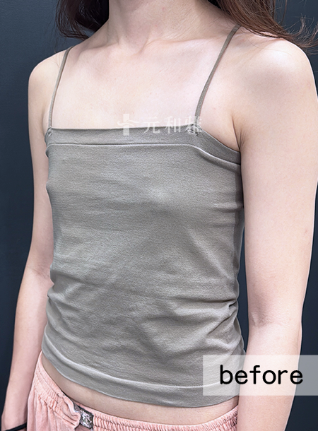 魔滴二代隆乳術前案例,台南隆乳,元和雅隆乳 魔滴二代隆乳術前案例,台南隆乳,元和雅隆乳