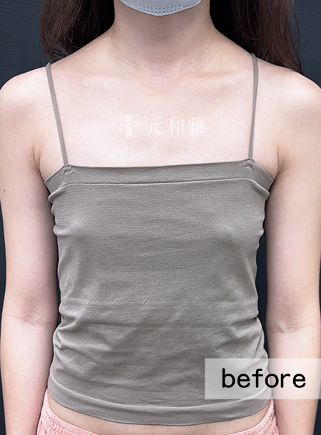 魔滴2.0隆乳術前案例,台南隆乳,元和雅隆乳 魔滴2.0隆乳術前案例,台南隆乳,元和雅隆乳