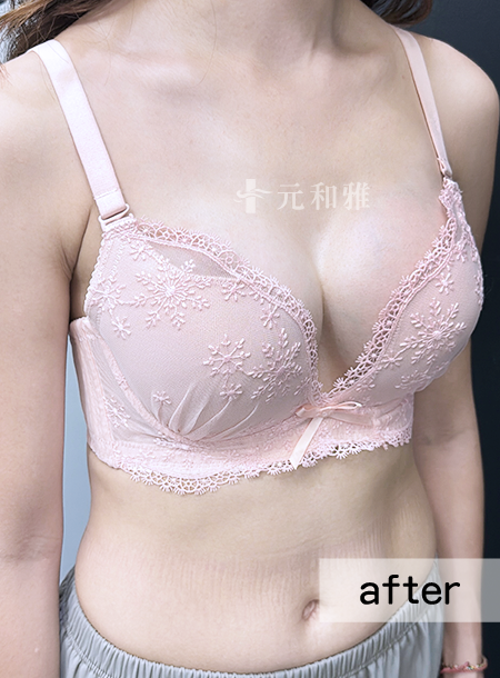 魔滴JOY隆乳術後案例,台南隆乳,元和雅隆乳 魔滴JOY隆乳術後案例,台南隆乳,元和雅隆乳