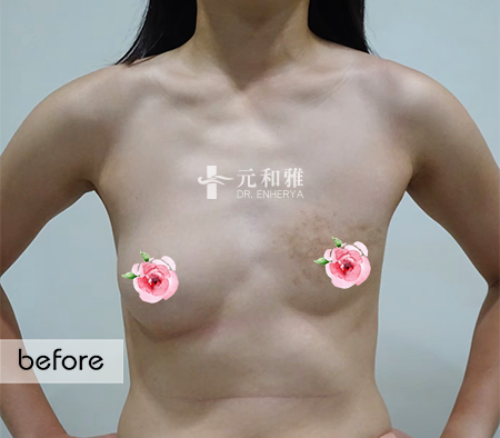 台南珍珠波隆乳