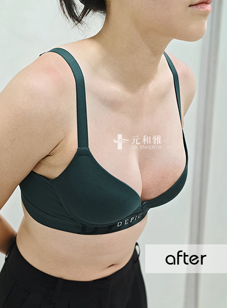 珍珠波隆乳術後