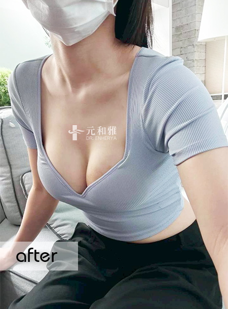 珍珠波隆乳心得