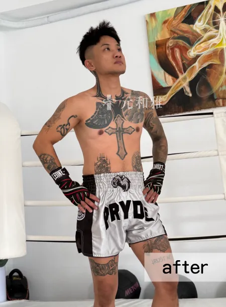 高雄平胸手術術後案例 高雄平胸手術術後案例