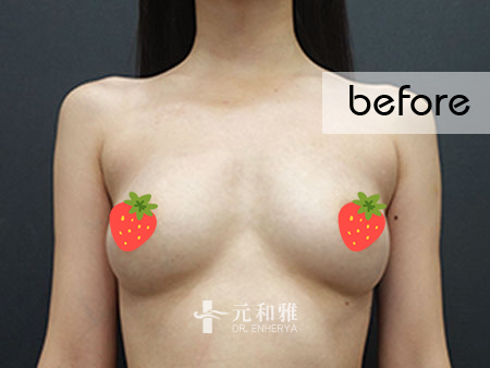 隆乳比例調整, 隆乳改善體態, 理性隆乳選擇