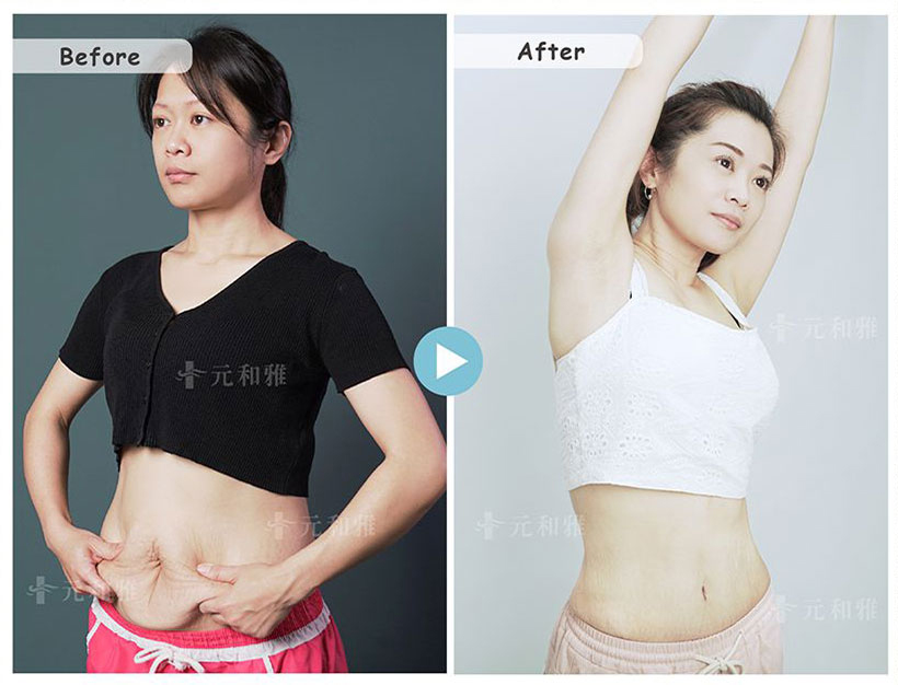 三寶媽的腹部拉皮與環抽心得1