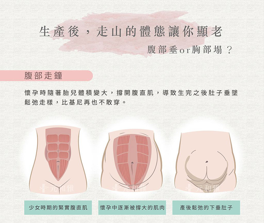 腹部拉皮手術