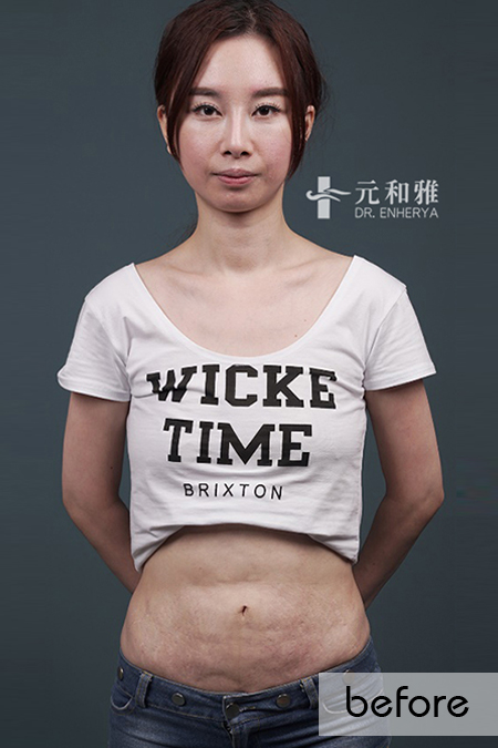 高雄腹部拉皮手術 高雄腹部拉皮手術