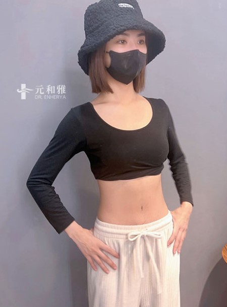 Abdominal Tightening Reconstruction Cases | Say Goodbye to Flabby Belly and Welcome Dreamy Waistline Recommendations in Taipei, Tainan, and Kaohsiung