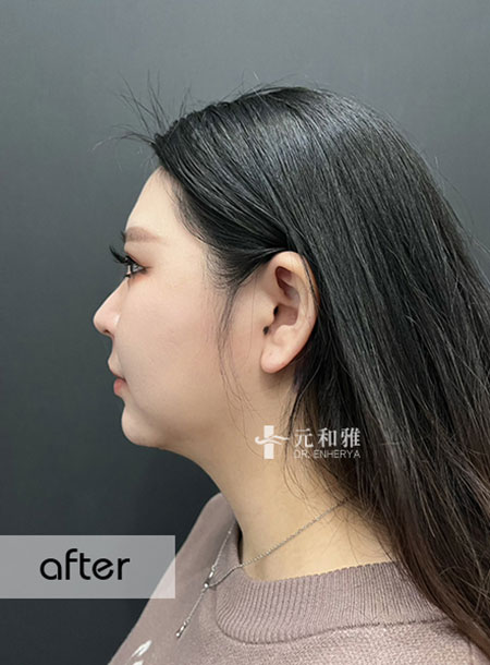 The neck lift surgery has restored the lost contour line, my side profile's highlight small V-line is back!