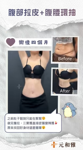 三寶媽困擾：產後肚皮鬆到懷疑人生  解決方案：腹部拉皮手術 🔥#台南腹部拉皮 #高雄腹部拉皮 #腹部拉皮手術