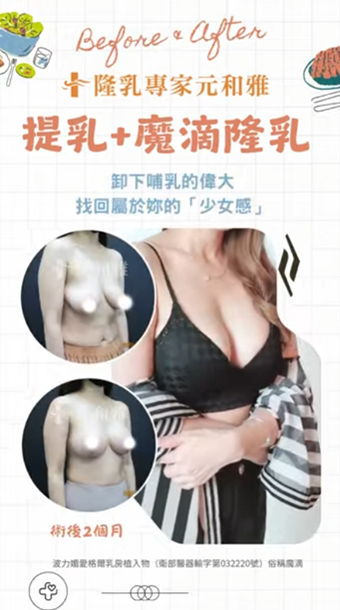 提乳+魔滴隆乳手術，告別布袋奶！如何不放假體也能擁有挺拔胸型！ #元和雅 #推薦 #提乳